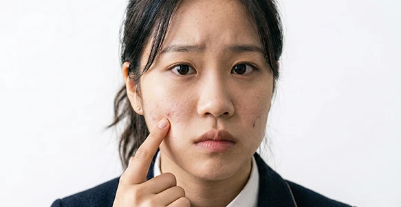 1020 여드름 이미지
