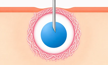 Solution Infusion 이미지