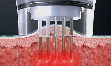 Thermal Pulse 이미지